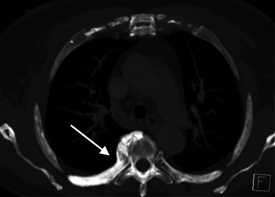 Axial MIP images of the thorax showing increased density of the right fifth rib