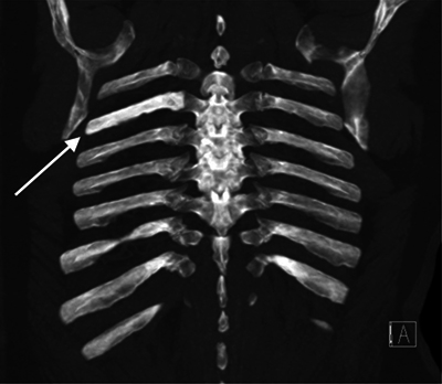 Coronal MIP images of the thorax showing increased density of the right fifth rib.