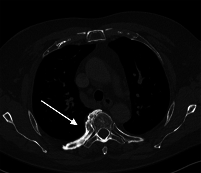 Axiale CT thorax showing diffuse cortical thickening of the posterior aspect of the right fifth rib with a lorge osseous excrescence at the fifth costovertebral joint.