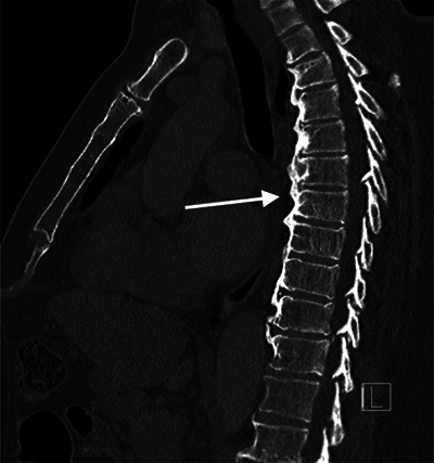 Sagittal images of the thorax showing diffuse idiopathic skeletal hyperostosis (DISH) with flowing osteophytes