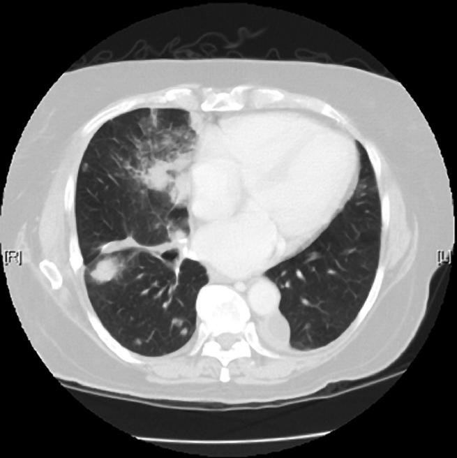 Assessing lung tumors for gene mutations could help guide therapy