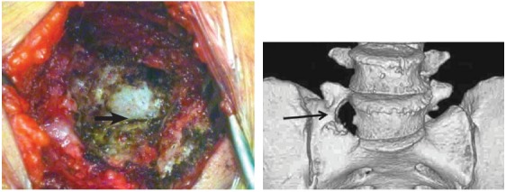 Figure 2: Intra-operative picture showing the pseudo-articulation between the
transverse process of L5 (superior) and sacrum (inferior)