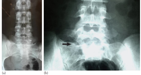 Figure 3: Pre-operative radiograph (a) Post-operative AP lumbar sacral
radiographs showing resected area with recreation of the gap between the
transverse process of the right L5 vertebrae and the sacrum (b)