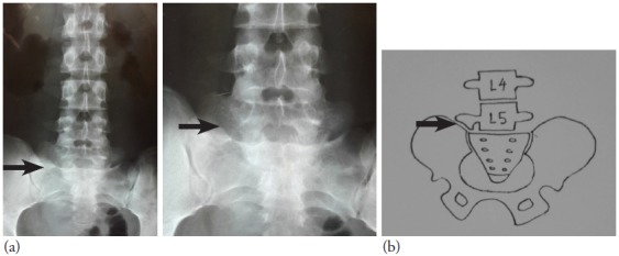 Figure 1: (a) Pre-operative anteroposterior (AP) lumbar sacral radiograph
showing the enlarged right L5 transverse process forming a pseudo-articulation
with the sacrum. The left transverse process and the sacrum are normal. (b)
Diagrammatic representation of the radiographs showing these
abnormalities