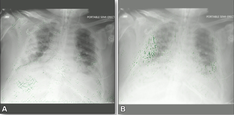 Example gradient-weighted class activation mapping images for two COVID-19 detection models. Both models have the same level of accuracy on the same test data. (A) Image shows a biased model localizing the incorrect part of the chest radiograph as the opacity. (B) Image shows a properly trained model localizing the correct part of the chest radiograph. Green dots represent localization.