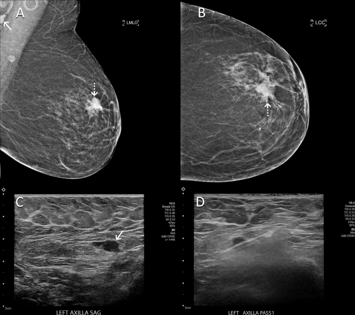 Images in a 60-year-old woman with no personal or family history of breast cancer who presented for routine screening mammography 9 weeks after COVID-19 vaccination in her left arm. (A) Mediolateral oblique and (B) craniocaudal mammographic views of the left breast demonstrate a new spiculated mass in the left breast (dotted arrows). In addition, a left axillary lymph node (solid arrow in A) had increased in prominence and density in comparison with that seen on her prior mammogram. (C) US scan shows a lymph node with eccentric cortical thickening measuring 6 mm (arrow) in the left axilla. (D) US-guided core biopsy of lymph node yielded metastatic carcinoma.