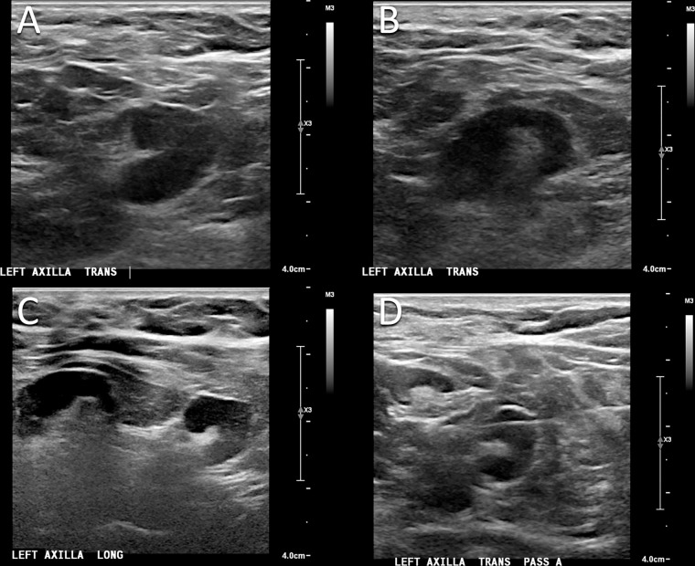 Images in a 50-year-old woman who presented for routine screening mammography and US 10 days after COVID-19 vaccination in her left arm. (A, B) Screening US scans demonstrate two prominent lymph nodes in the left axilla, with cortical thickening measuring up to 6 mm. (C) Targeted US scan obtained at 3-month follow-up demonstrates persistent lymphadenopathy. (D) US-guided core biopsy was performed, and pathologic examination yielded a benign reactive lymph node without evidence of malignancy.