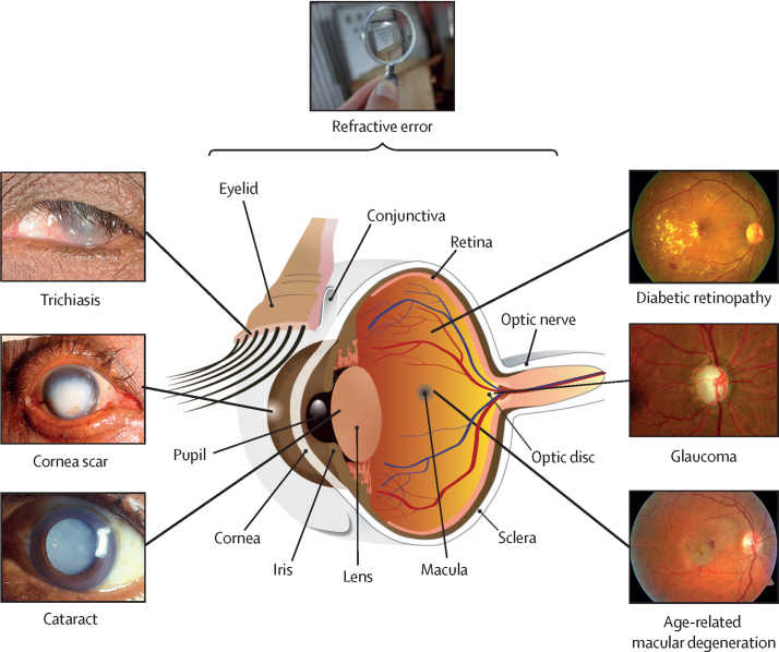 Photographic images of the external appearance of trichiasis, corneal scar, cataract, diabetic retinopathy, glaucoma, and age-related macular degeneration, with arrows pointing to the affected part on a cross-sectional diagram of the eye. The purpose is to show the complexity of the visual system.