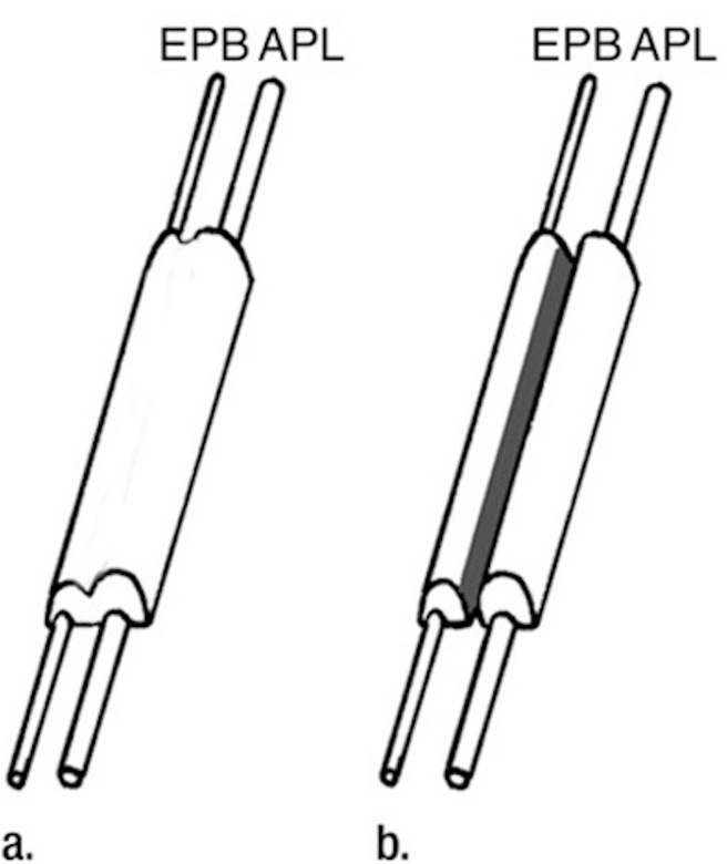 Figure 1. (a) APL and EPB run in the same fibro-osseous sheath (b) APL and EPB run in two compartments separated by a fibrous septum.