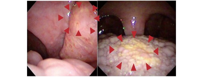 Fig.2. Orange-colored tonsils observed in male patient with Tangier disease in his 50s