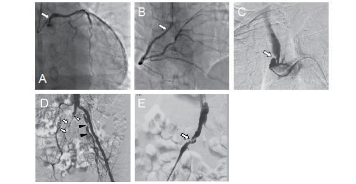 Fig.4. Advanced systemic atherosclerotic lesions in male patient with Tangier disease in his 50s