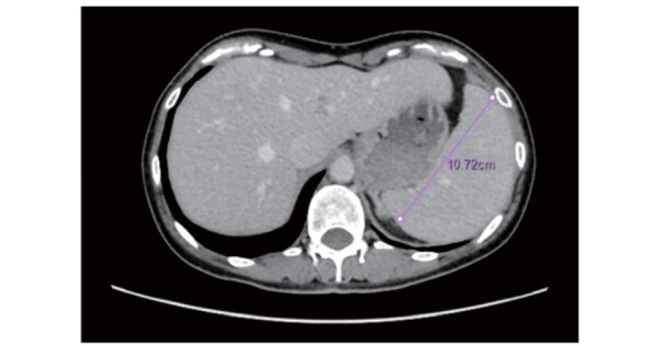 Fig.3. Abdominal CT scan of splenomegaly in female patient with Tangier disease in her 40s