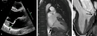 Images in a 24-year-old asymptomatic female patient with mitral valve
prolapse diagnosed at 3 years of age. (A) Her electrocardiogram showed
normal sinus rhythm. A three-chamber view at echocardiography showed a 10-mm
gap between the mitral valve hinge point and left ventricular myocardium
(black arrow). On the (B) two-chamber and (C) three-chamber views of cine
steady-state free precession cardiac MRI, this gap was confirmed in the
end-systolic phase and measured 6 mm (black arrow).
