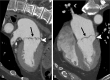 Images in a 73-year-old male patient who presented with chest pain and
underwent workup for acute coronary syndrome. Cardiac CT angiograms show
incidental mitral valve prolapse with thickening and prolapse of the mitral
valve leaflets (black arrow) and 7-mm disjunction of the posterior mitral
annulus (white arrowhead), as shown on the end-systolic (A) two-chamber and
(B) four-chamber view images.