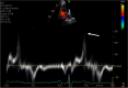 Pickelhaube sign at tissue Doppler imaging. A high-velocity
midsystolic spike of the mitral valve annulus (more than 16 cm/sec)
resembles a German military helmet with a spike (arrow).