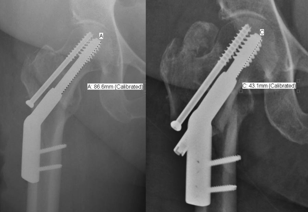 Cephalomedullary nail versus sliding hip screw for fixation of AO 31 A1 ...