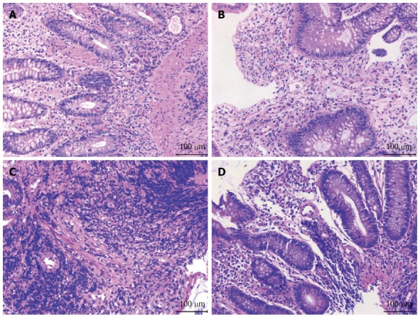 Successful treatment of ileal ulcers caused by immunosuppressants in ...