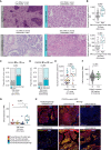 Figure 5. Neutrophil-rich TMEs are associated with activating mutations in PI3K and tumor-intrinsic CXCL8 upregulation. A, Representative crops of tumor-level H&E images with low TAN scores in the tumor nest and stroma (left) and high TAN scores in the tumor nest and stroma (right), inferred as the proportion of the neutrophil area in tumor/stroma from the total tumor/stroma tissue area. Scale bar, 50 μm; 400× magnification. B, Neutrophil cell density as defined by IMC compared between region-level TAN-low versus TAN-high tumor cores based on H&E scores in LUAD and LUSC. C and D, Proportion of tumor cores with (mut) and without (wt) PIK3CA driver mutations compared between TS:Neutrophil high versus other TME classes combined (C) and region-level TAN-High versus TAN-Low cores (D) in LUSC. P values were derived from a Chi-square test. E, Neutrophil cell density by PIK3CA mutation status, points colored by TME class assignment. F and G, TMM expression values for CXCL8 compared by PIK3CA mutation status (F) and between TME classes (G) in LUSC. H, Immunofluorescence images of CXCL8 RNAscope multiplexed with antibody staining of pancytokeratin (panCK) or MPO in an LUSC tumor region with a TS:Neutrophil high TME and subclonal PIK3CA mutation, and an LUSC patient with multiple TAN-high tumor regions and a clonal PIK3CA mutation. panCK and MPO examples for CRUK0075:R2 illustrate the same region of interest, whereas different regions of interest are shown for CRUK0468:R6. Scale bar, 100 μm. P values for B and E were calculated in a linear mixed-effects model with patient as the random-effect covariate. P values in F and G were derived from a limma–voom differential expression analysis correcting for multiple regions per tumor. ·, P < 0.1; *, P < 0.05; **, P < 0.01; ***, P < 0.001; LUAD, lung adenocarcinoma; LUSC, lung squamous cell carcinoma; TMM, trimmed mean of M-values; TS, tumor/stroma; TIL, tumor-infiltrating lymphocyte; MΦ, macrophage; TAN, tumor-associated neutrophils; H&E, hematoxylin and eosin; mt, mutant; wt, wild-type.