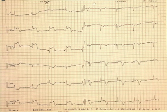 Vasospastic myocardial infarction: An even rarer occurrence of a rare ...