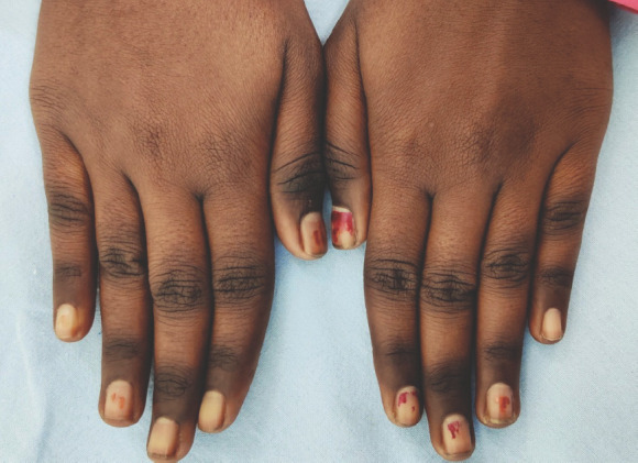 Knuckle Pigmentation As An Early Cutaneous Sign Of Vitamin B12 knuckle-pigmentation-as-an-early-cutaneous-sign-of-vitamin-b12