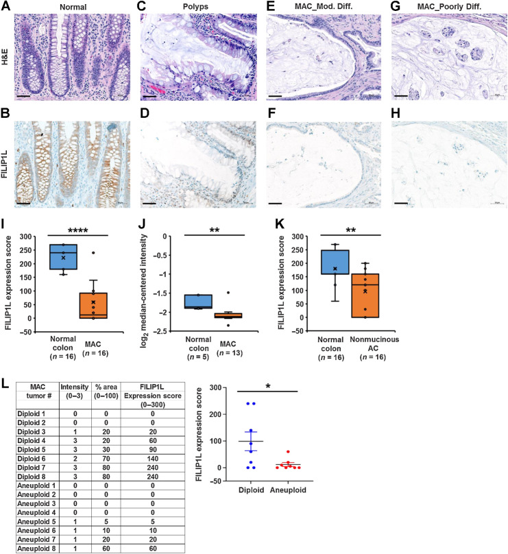 Figure 2. FILIP1L is downregulated in mucinous colon cancer. H&E staining (A, C, E, and G) and FILIP1L expression (B, D, F, and H) was analyzed in specimens from NATs (n = 16), serrated polyps (n = 9), well/moderately differentiated mucinous adenocarcinoma (n = 4), and poorly differentiated mucinous adenocarcinoma (n = 12). Note that multinucleated cells were not present in serrated polyps samples. Scale bar, 50 μm. I, FILIP1L expression in IHC stained slides (as shown in panels B, F, and H) was compared between matched normal (n = 16) and mucinous colon adenocarcinoma (n = 16). Expression score was carried out as described in Materials and Methods. J, FILIP1L mRNA expression was compared between normal (n = 5) and mucinous colon adenocarcinoma (n = 13). Data are derived from Oncomine public databases [Kaiser Colon (http://www.ncbi.nlm.nih.gov/geo/query/acc.cgi?acc=GSE5206)]. K, NATs (n = 16), well/moderately differentiated nonmucinous colorectal adenocarcinoma (n = 9), and poorly differentiated nonmucinous colorectal adenocarcinoma (n = 7) were stained for FILIP1L, and expression score was carried out as described in I. L, DNA ploidy in 16 MAC tumors used in I was analyzed. FILIP1L expression score of each tumor is shown in table, and either diploid or aneuploid tumors were plotted against FILIP1L expression score. *, P < 0.05; **, P < 0.01; ****, P < 0.0001.