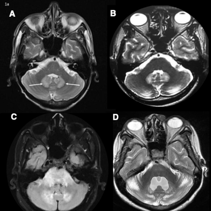 Imaging of Dentate Nucleus Pathologies: A Case Series - PMC