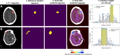 Illustration of the interpretability of our weakly supervised model for localizing ICH at the image and pixel level. The model was trained at the study level, but the attention weights indicate the probability, from 0 to 1, of each image showing ICH (column 5). The model generated heatmaps on predicted ICH images (designated by red arrows in column 5) to localize specific ICH regions (shown in column 4). The heatmaps were converted to a pixel-level mask and quantified by Dice scores (column 3), which were computed by comparison with the reference standard segments (column 2) manually annotated by radiologists (column 1). Grad-CAM = gradient-weighted class activation map, ICH = intracranial hemorrhage.