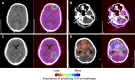 Gradient-weighted class activation map (Grad-CAM)–generated heatmaps to highlight important features for predicting intracranial hemorrhage (ICH) and to visualize the possible regions of ICH. In each figure part, the raw CT image is on the left, and the heatmap generated by Grad-CAM is on the right. (A, C) Examples from our institution’s test set, not annotated by radiologists. The color map (right) indicates possible ICH regions. (B, D) Examples from our institution’s test set, manually annotated by radiologists, where the red mask (left) represents the ICH, and the color map (right) indicates possible ICH regions.
