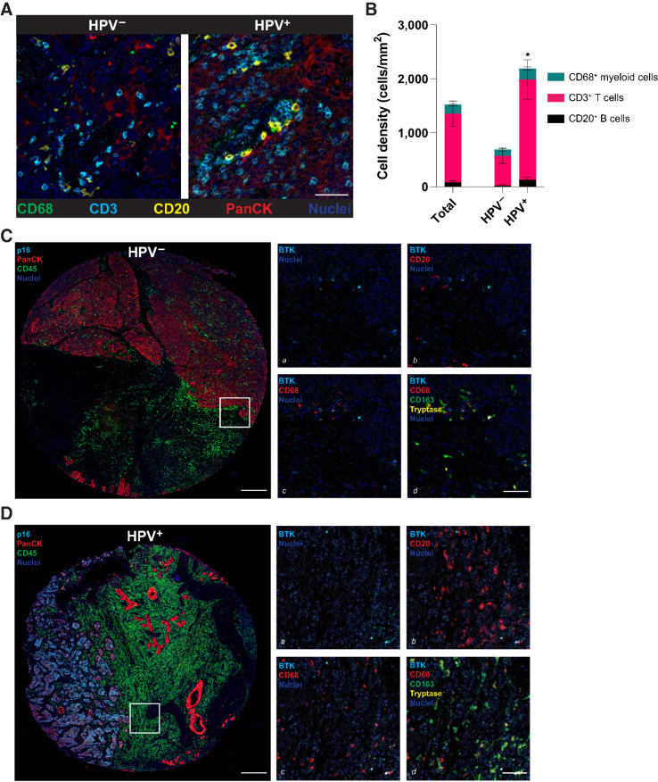 Figure 1. Immune cell abundance in HPV− and HPV+ HNSCC tumors. A, Pseudocolored images from mIHC staining of representative HPV− and HPV+ HNSCC tumors, indicating neoplastic (PanCK+) and immune (CD68, CD3, and CD20) cell lineages. B, Quantitation of CD68+ myeloid cell (CD45+CD3/CD20/CD56−CD66b−Tryptase−CD68+CSF1R+CD163+/−), CD3+ T cell (CD45+CD3+), and CD20+ B cell (CD45+CD3−CD56−CD20+) abundance in all HNSCC samples evaluated (left bar, “total”) and stratified by HPV status: HPV− (n = 17) and HPV+ (n = 21) HNSCCs. Stacked bars indicate mean ± SEM. Asterisks, P < 0.05 for CD3+ T cell abundance (pink). Pseudocolored images showing BTK immunoreactivity and co-expression with lymphoid and myeloid lineage markers in HPV− (C) and HPV+ (D) HNSCC. Low-magnification images at left show representative tissue microarray cores showing location of HPV− (p16−) and HPV+ (p16+; cyan) neoplastic (PanCK+; red) cells in proximity to immune cell (CD45+; green) infiltrates. Higher magnification regions (boxed area from left panels shown at higher magnifications on right) show BTK positivity (a, cyan) alone, in addition to CD20 (b, red), CD68 (c, red), and together with CD68 (red), CD163 (green), and Tryptase (yellow; d). Co-localization of BTK staining with CD163 and mast cell tryptase staining (d) is evident. BTK, Bruton's tyrosine kinase; HNSCC, head and neck squamous cell carcinoma; HPV, human papillomavirus; PanCK, pan-cytokeratin; SEM, standard error of the mean.