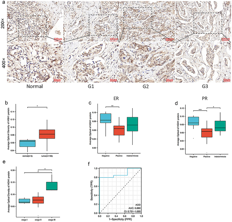 AltText: HGH1 highly expressed in BRCA clinical tissues.