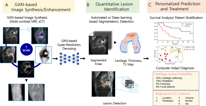 Schematic of future applications of generative adversarial networks (GANs) to musculoskeletal imaging chain and clinical management. A, Flexible multiple domain translation tasks using GANs will create various synthetic radiologic images (eg, MRI contrast or modality conversion). GAN-based super-resolution and denoising methods offer the potential to enhance image quality using lower radiation dose and reduced scan and reconstruction time. B, Machine learning methods (eg, GAN-based segmentation or detection models) are applied for tissue and lesion identification to extract quantitative information from images. C, Use of computer-aided diagnosis systems to evaluate the information to make personalized predictions of disease diagnosis, treatment planning, and survival analysis. DL = deep learning, sCT = synthetic CT.