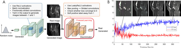 Walk-through of generative adversarial network (GAN) training. A, Stability tips to improve GAN performance (Table 3). B, Example of image generation progress of GANs for joint effusion synthesis. The generated images at corresponding training stages are superimposed on the training loss graph. The generator and discriminator loss oscillates. Images from Clinical Hospital Centre Rijeka, Croatia (85). D loss = discriminator loss, G loss = generator loss, ReLU = rectified linear unit.