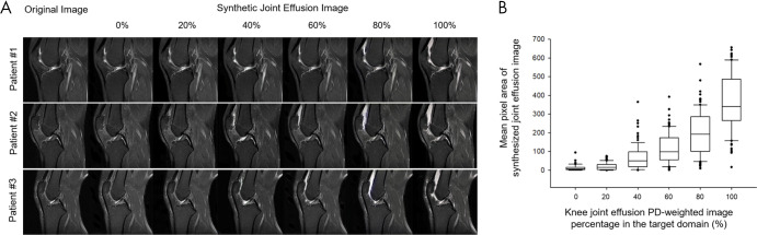 A, Joint effusion synthesis from healthy class through CycleGAN domain translation while the ratio of joint effusion samples in the target domain is increased. The distribution of joint effusion samples is increased from 0% to 100%, in increments of 20%. The images of the source domain (knee MRI without effusion) are shown in the left-most column, with the translated image in the target domain shown in the right-most column. The magnitude of the joint effusion increases from left to right. B, The graph (box plots) for the mean pixel area of synthesized joint effusion images with different ratios of joint effusion samples in the target domain. The horizontal line in each box represents the median (50th percentile) of the calculated strain ratios, and the top and bottom of each box represents the 25th and 75th percentiles, respectively. Images from Clinical Hospital Centre Rijeka, Croatia (85). GAN = generative adversarial network, PD = proton-density.