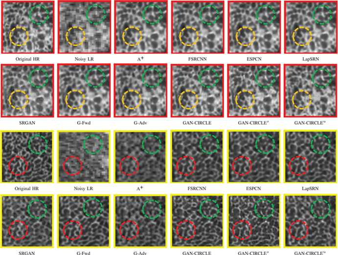 Comparison of CT super-resolution and denoising case from micro-CT tibial bone images. The zoomed regions of interest of tibial bony structures are shown in boxes outlined in red or yellow. Generative adversarial network constrained by the identical, residual, and cycle learning ensemble (GAN-CIRCLE) recovers subtle structures and fine details better than other variations of the proposed networks, particularly in the regions marked by green, yellow, and red circles. The results of semisupervised GAN-CIRCLE (GAN-CIRCLEs) predict sharper images and richer anatomic textures compared with unsupervised GAN-CIRCLE (GAN-CIRCLEu). (Reprinted, with permission, from reference 44.) A+ = adjusted anchored neighborhood regression, ESPCN = efficient subpixel convolutional neural network, FSRCNN = fast super-resolution convolutional neural network, G-Adv = G-Adversarial, G-Fwd = G-Forward, HR = high-resolution, LapSRN = Laplacian pyramid super-resolution network, LR = low-resolution, SRGAN = super-resolution generative adversarial network.