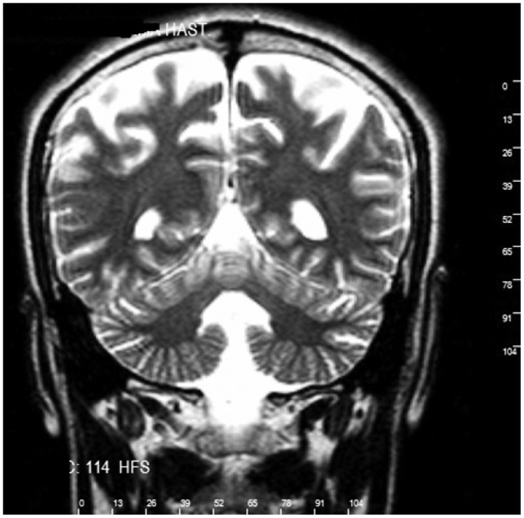 Dandy Walker Variant And Bipolar I Disorder With Graphomania - Pmc