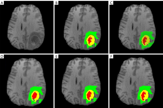 Segmentation method of magnetic resonance imaging brain tumor images ...