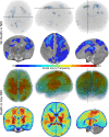 Acute injury frequency map for the two primary outcome groups displayed as colorized heat maps. Frequency maps for participants who did not die or have neurodevelopmental impairment (NDI) at follow-up are shown in the top two rows. The top row shows superior, lateral, and anterior projection views of volume rendered injury maps, with cool colors indicating relatively low injury frequency. The second row shows coronal, axial, and sagittal sections of the population-averaged neonatal brain atlas with colorized heat map overlays using the same color scale. The location of the displayed sections is indicated on the volume rendered projections with a dotted line. Brain regions where there was no acute injury in this outcome group are displayed as clear to show the underlying brain atlas anatomy (gray scale). Rows 3 and 4 are identical to rows 1 and 2 except that they represent frequency of acute injury in participants who died or had NDI at follow-up. Warm colors indicate a relatively higher frequency of acute injury and correspond to typical locations of acute brain injury described in the setting of hypoxic ischemic encephalopathy.