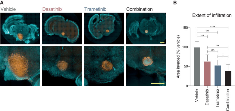 Figure 7. Efficacy of combined dasatinib and trametinib on ex vivo brain slice preparations. A, Coronal slices of normal mouse brain, counterstained with Hoechst 33342 (aqua), are implanted in the pontine region with ICR-B169 parental cells, stained with human nuclear antigen (orange), and treated for 4 days with 1 μmol/L dasatinib, 0.1234 μmol/L trametinib, or both compared with vehicle control. Scale bars, 2 mm. B, Bar plot of quantification of tumor cell infiltration across the brain parenchymal tissue as measured by the calculated area invaded compared with vehicle control. Plotted is the mean of at least six independent slices; error bars represent the SD. *, P < 0.05; **, P < 0.01; ***, P < 0.001; ****, P < 0.0001; ns, not significant, FDR-corrected t test.