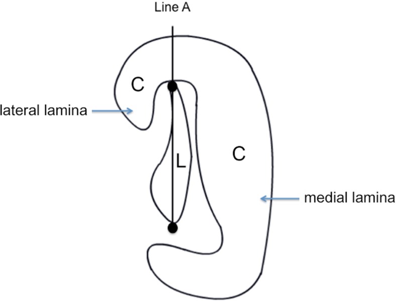 The role of the tensor veli palatini muscle in the development of cleft ...