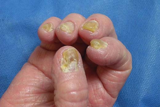 Nail Alterations In Cutaneous T-cell Lymphoma: A Case Series And Review 