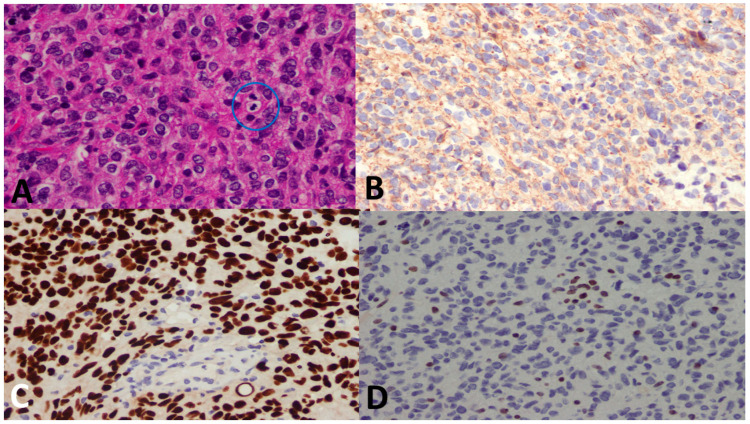 Midline Gliomas: A Retrospective Study From A Cancer Center In The 