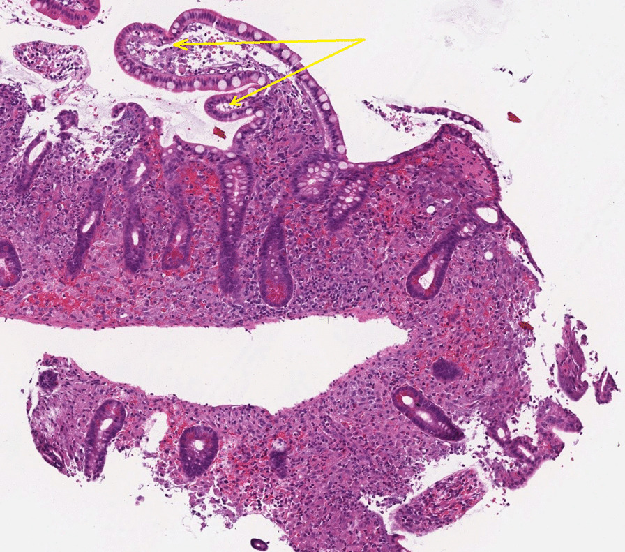 Whipple's disease: the great masquerader—a high level of suspicion is ...