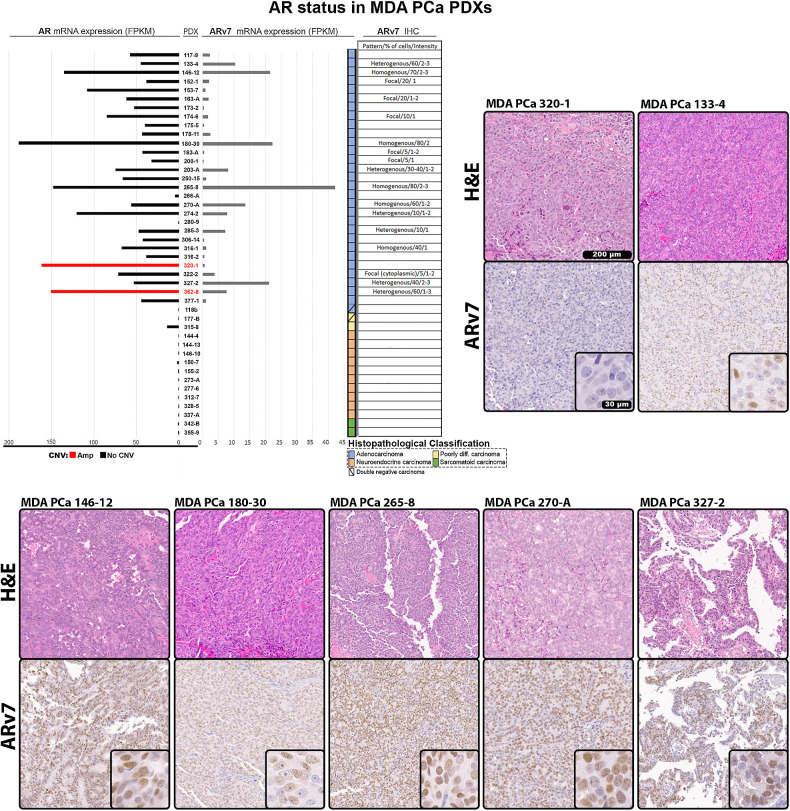 Figure 3. AR status in MDA PCa PDXs. Expression of AR and ARv7 evaluated from RNA-seq data in MDA PCa PDXs. AR bars in the chart are depicted in red for AR amplification or black for no CNV. Table and representative images show IHC for ARv7 performed in samples from the 44 MDA PCa PDX models. Scale bar: 200 μm and 30 μm in magnified section. Blank spaces in the table correspond to negative staining. Staining was evaluated by semiquantitative analysis of pattern, percentage of cells, and intensity on a scale of 1 to 3. FPKM, fragments per kilobase of transcript per million mapped reads.