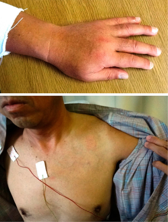 Upper extremity deep vein thrombosis complicating apheresis in a