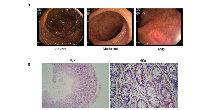 Histopathology of melanosis coli and determination of its associated ...