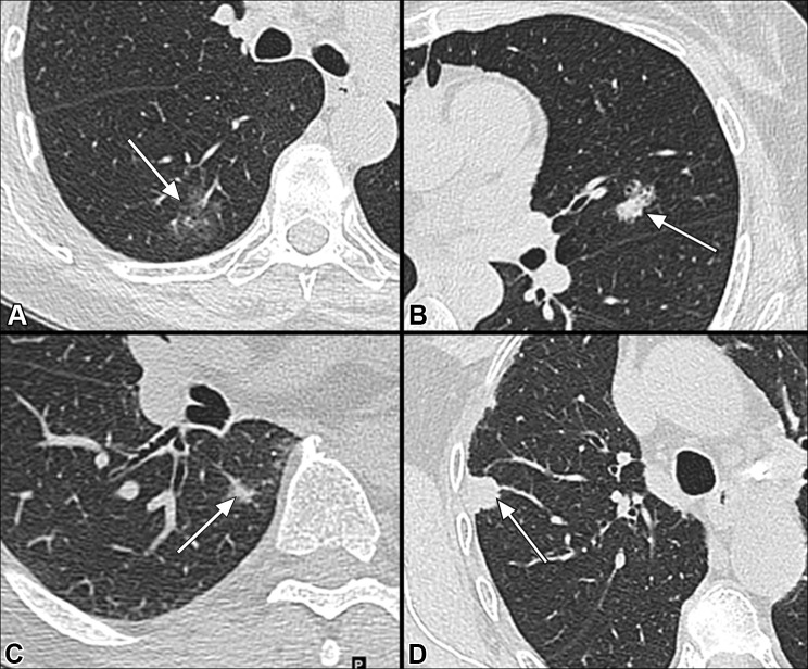 Thin-section CT images of lesions used for radiomic cluster analysis. (A) Cluster 1. Ground-glass nodule in the right lower lobe (arrow) measuring 2.2 cm, predominantly lepidic histologic subtype, EGFR, and phosphoinositide 3-kinase (pPI3K) positive. Follow-up was 35 months without evidence of recurrence. (B) Cluster 2. Part-solid nodule in the left upper lobe (arrow) measuring 2.1 cm, solid and micropapillary histologic subtype, spread through air spaces (STAS) positive, STK11 and KRAS positive. Follow-up was 40 months without evidence of recurrence. (C) Cluster 3. Solid nodule (arrow) with thin ground-glass halo in the right lower lobe measuring 1.0 cm; solid and micropapillary histologic subtype; STAS positive; TP53, pPI3K, and receptor tyrosine kinase-Ras positive. The patient underwent right lower lobe wedge resection and was diagnosed with recurrence 9 months after resection. (D) Cluster 4. Solid nodule (arrow) in the right upper lobe measuring 1.4 cm; solid and micropapillary histologic subtype; STAS and lymphovascular invasion positive; STK11, KRAS, and pPI3K positive. The patient underwent right upper lobectomy and was diagnosed with recurrence 15 months after resection.