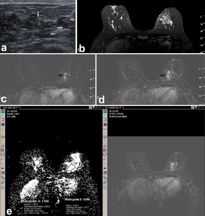 Stromal fibrosis: imaging features with diagnostic contribution of ...