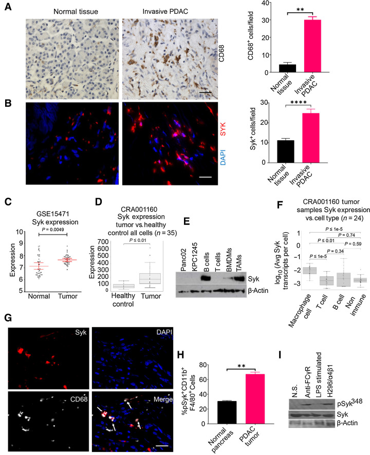 Figure 1. Syk-positive macrophages accumulate in murine and human PDAC. A and B, Left, IHC or IF staining of human invasive PDAC patient sample and normal pancreas for CD68 (A) and SYK (B). Scale bar, 20 μm. Right, quantification of CD68+ macrophages or SYK+ cells/40× microscopic field in the tissue sections (n = 3). The tissue sections were stained with DAPI to detect nuclei in B. Statistical significance was determined by Student t test. C and D, Relative SYK mRNA expression in human PDAC as compared with normal pancreas tissue in data set GSE15471 (C) and scRNA-seq data set (CRA001160; D). Statistical significance was determined by Wilcoxin-signed rank test. E, Western blot images showing expression of Syk and β-actin in cell lines, B cells, T cells, BMDMs, and TAMs. F, Syk expression in macrophages, B cells, and nonimmune cells in human PDAC, using scRNA-seq data set (CRA001160). G, Figure shows IF staining of Syk (red) and CD68 (aqua) in a tissue section from human invasive PDAC. The dual-positive cells are indicated by arrows. Scale bar, 10 μm. H, FACS quantification of pSyk348+ CD11b+F4/80+ cells in normal pancreas and KPC1245 PDAC (n = 3). I, Immunoblot showing pSyk348 activation in Panc02 PDAC TAMs stimulated with Fc gamma ligation, 1 μg/mL LPS, or adhered to H296 (ligand for α4β1). **, P < 0.01; ****, P < 0.0001. N.S., no stimulation.