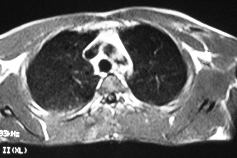 Surgical repair of a rupture of the pectoralis major muscle - PMC