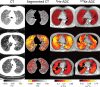 Representative axial CT lung images, segmented CT images with voxels having attenuation coefficient levels less than −950 HU and −910 HU displayed in yellow and red, respectively, and corresponding helium 3 (3He) and xenon 129 (129Xe) apparent diffusion coefficient (ADC) maps. In top row, CT image in healthy 60-year-old man shows uniformly dense parenchyma throughout lung and uniformly low ADC values in both 3He and 129Xe ADC maps. In middle row, CT in 75-year-old man with stage III chronic obstructive pulmonary disease (COPD) depicts large areas of lung parenchyma with low attenuation coefficients. Clear visual concordance is present between these areas in CT image and elevated ADC values in corresponding 3 He and 129Xe ADC maps. CT RA950 and ADC emphysema indices are well outside healthy range (>0.04), indicating that with all techniques participant is identified as emphysematous. In bottom row, clear difference in performance is seen in 68-year-old woman with stage III COPD. Very few pixels in CT image cross −950 HU threshold, whereas both ADC maps show extensive lung regions with elevated values. Accordingly, both ADC-based emphysema indices for this participant lie well outside healthy range, but CT RA950 does not (RA950 = 0.01; ADC emphysema index = 0.25 and 0.21 based on 3He and 129Xe, respectively). RA950 = fraction of CT lung voxels with attenuation coefficients less than −950 HU.